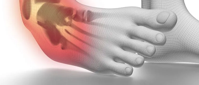 Ankle cartilage injury illustration
