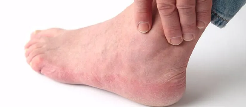 Ankle arthritis illustration