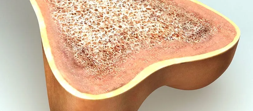 Bone marrow lesions illustration