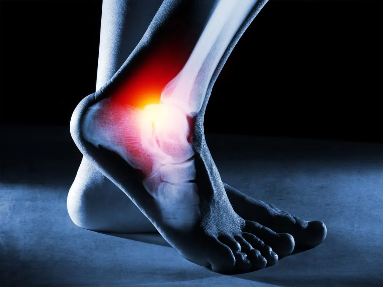 An X-ray of an ankle showing the injury site