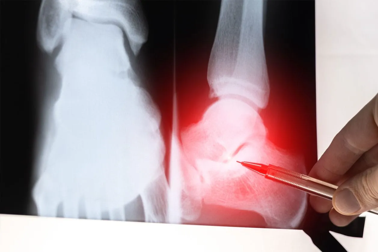 A doctor pointing to an x-ray of an injured ankle